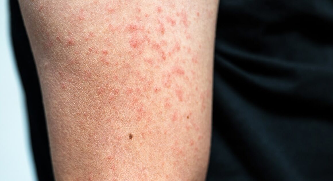 Measles cases in the U.S. are already triple last year’s total, and it’s only July