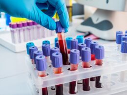 New breakthrough blood testing technology can accurately diagnose Alzheimer’s in 90% of dementia cases