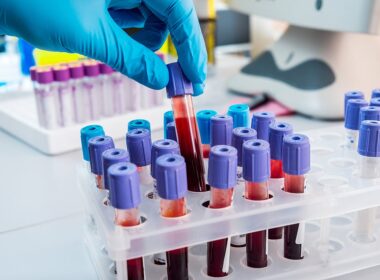 New breakthrough blood testing technology can accurately diagnose Alzheimer’s in 90% of dementia cases