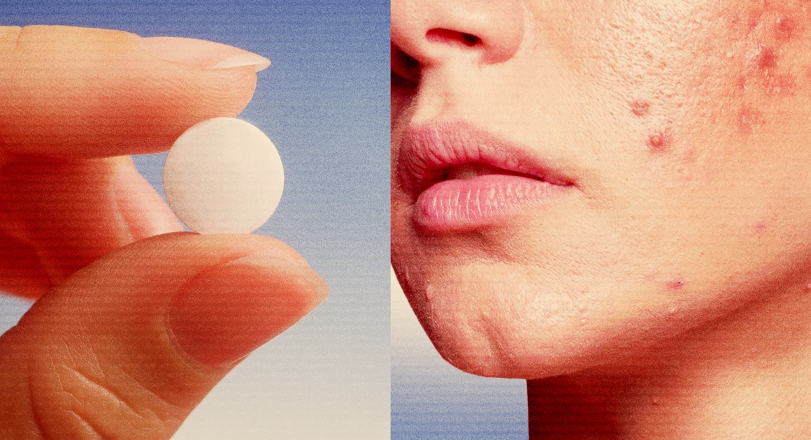 The most popular pill to treat women’s acne is a blood pressure drug