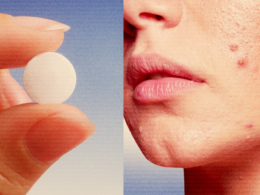 The most popular pill to treat women’s acne is a blood pressure drug