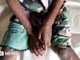 WHO declares mpox global health emergency