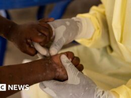 First case of more contagious mpox found outside Africa